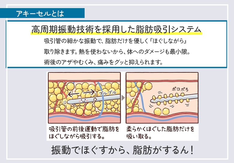 アキ―セルは脂肪吸引械の一種