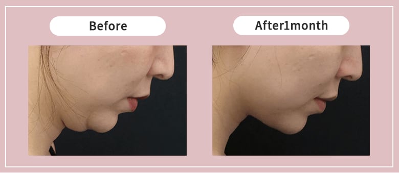 二重あご解消の新提案！