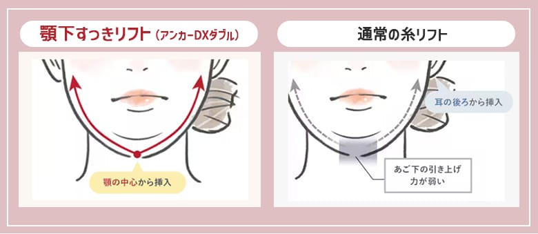 あご下の高い引き上げ力