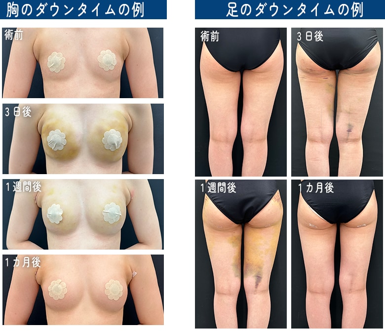 胸と足の内出血