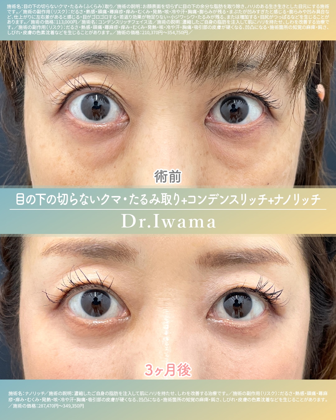 目の下の切らないクマ・たるみ取り+コンデンスリッチフェイス+ナノリッチ