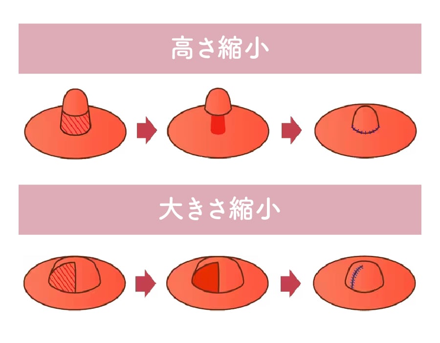 乳首の大きさ・高さが気になる方へ『乳頭縮小術』