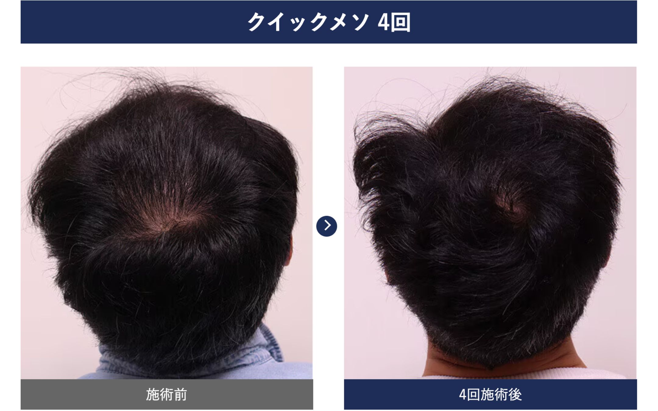 【短期間で確実にボリュームUP】クイックメソ