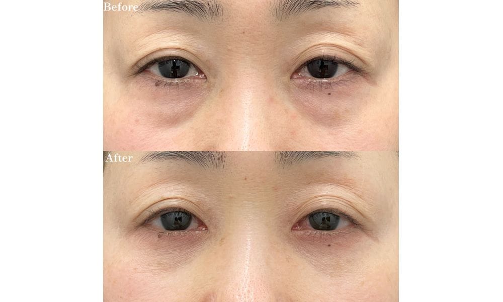 50代 裏ハムラ