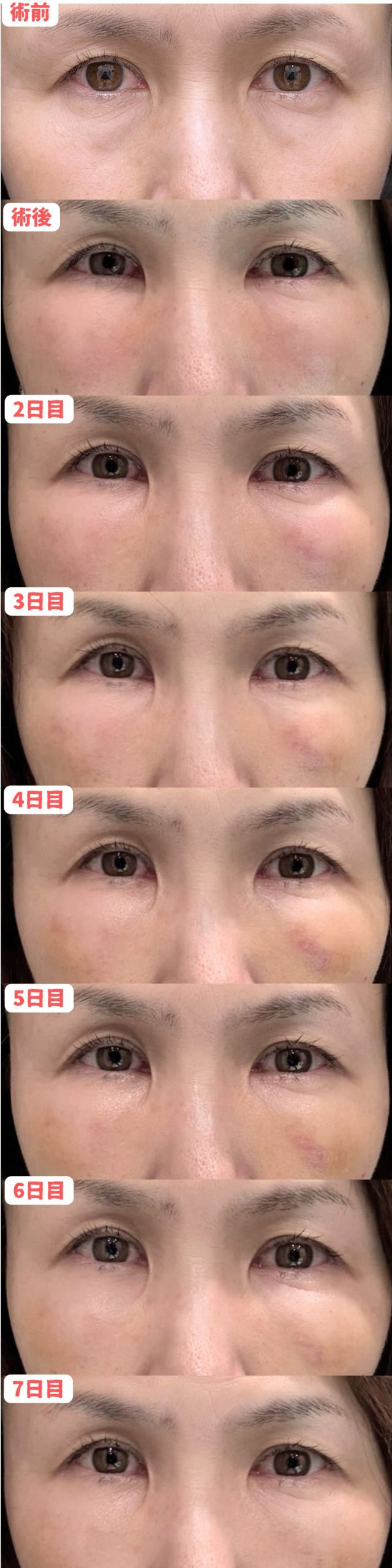 目の下の切らないクマ・たるみ(ふくらみ)取り＋コンデンスリッチ＋ナノリッチ 50代