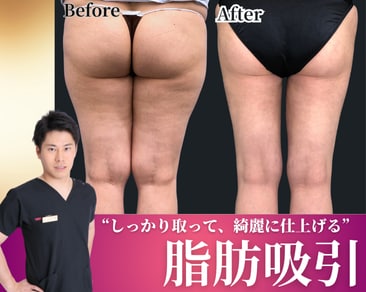 【小倉・福岡・山口で脂肪吸引を検討中の方へ】脂肪吸引が上手い医師をお探しなら小倉院岩間医師にお任せください！