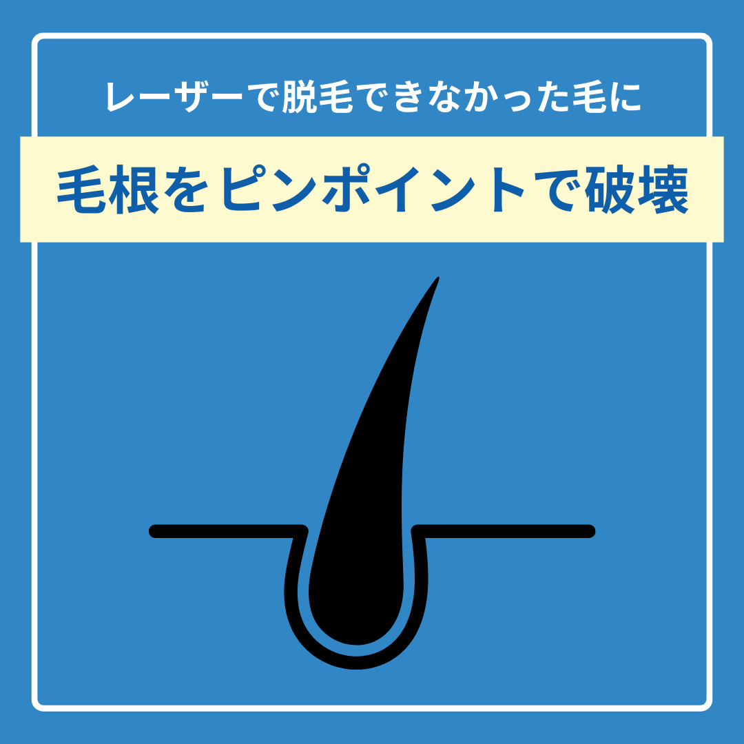 SBC小倉院のニードル脱毛｜北九州・山口(下関)からも便利！ピンポイント永久脱毛