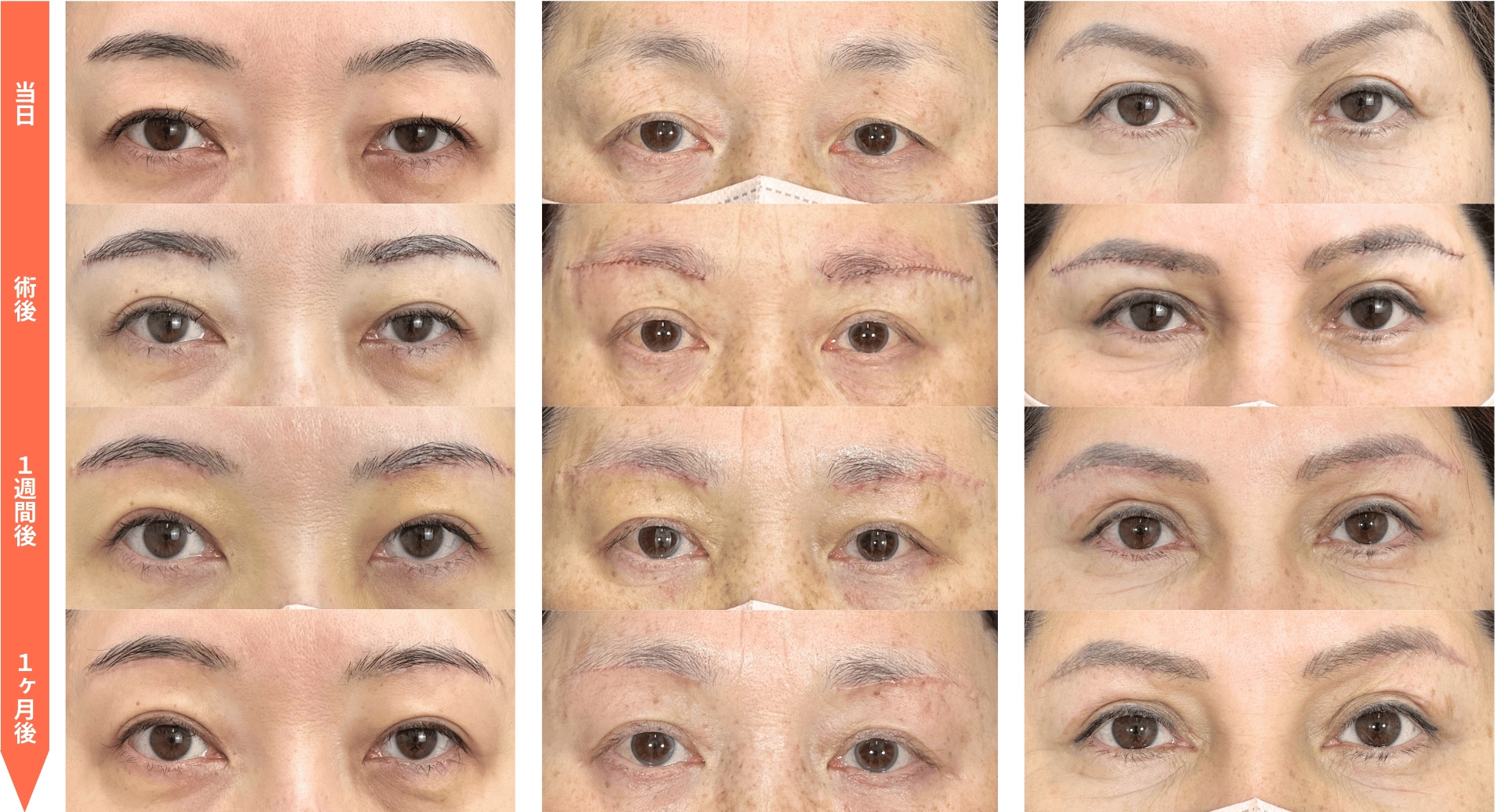 小倉院の【眉下リフト】で、自然な若返りを実現！傷跡が目立たない 