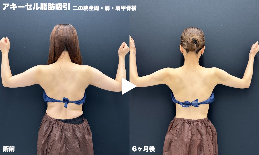 アキーセル脂肪吸引(岩間院長症例)
