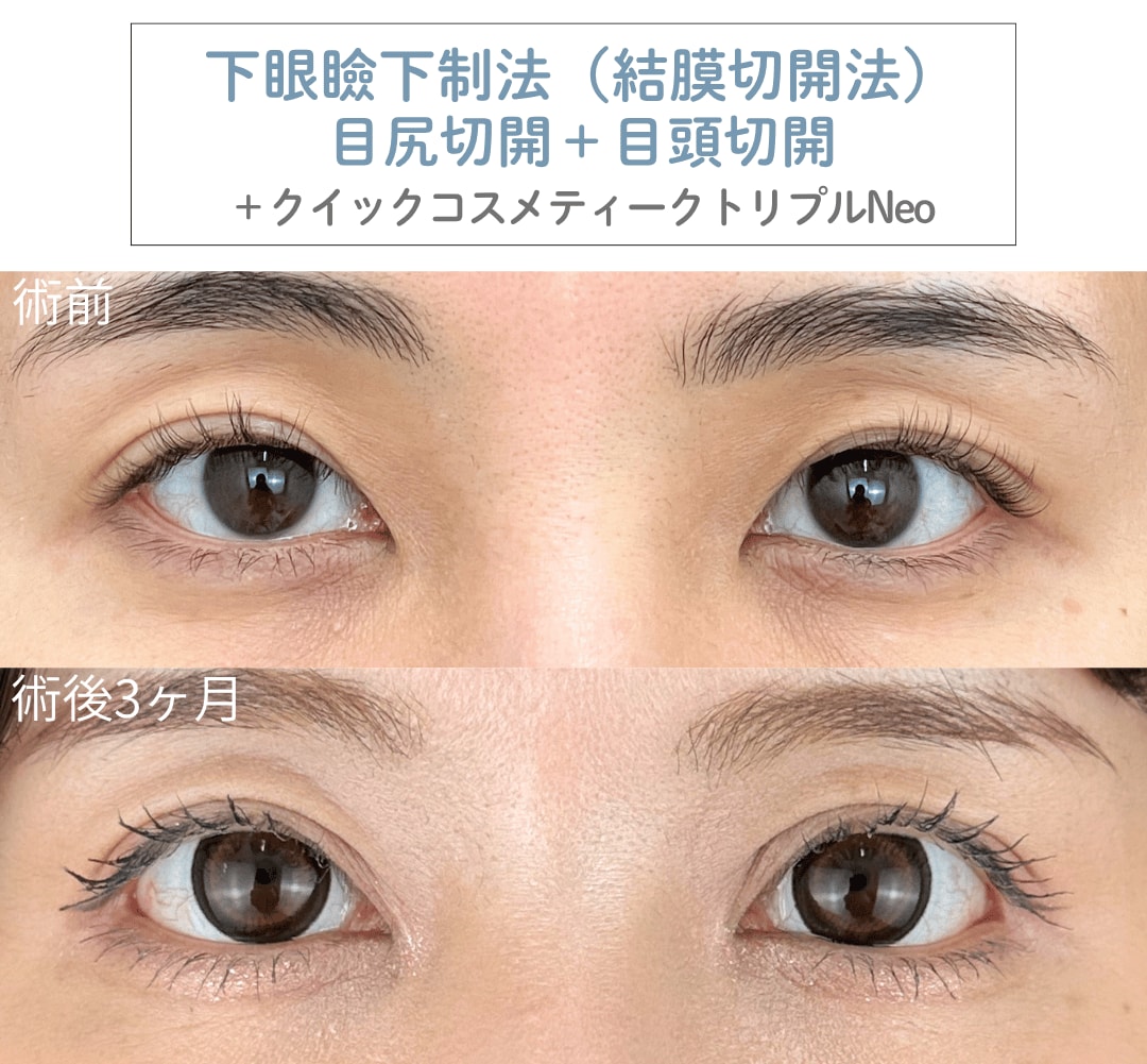 目尻切開+下眼瞼下制法(結膜切開法)