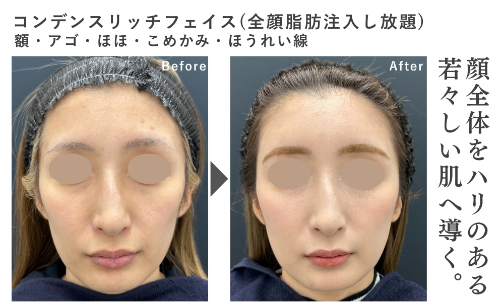 クマ取りと脂肪注入を併用して若返り！