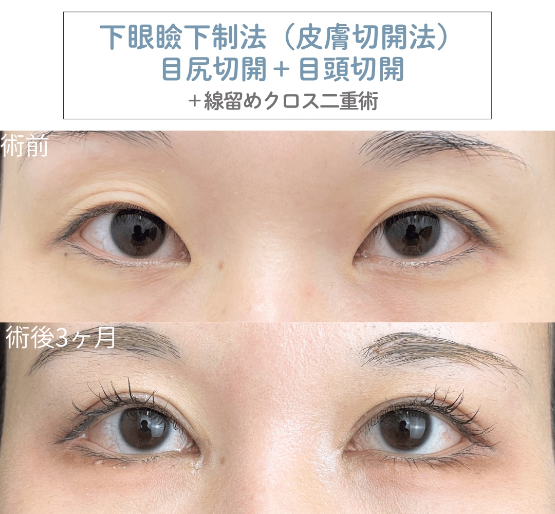 目尻切開+下眼瞼下制法(皮膚切開法)