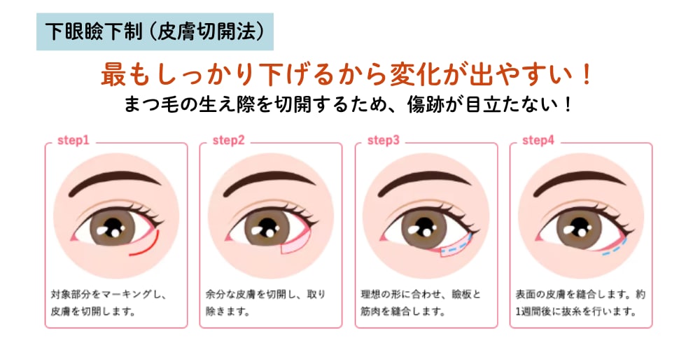 下眼瞼下制法の違いとは?
