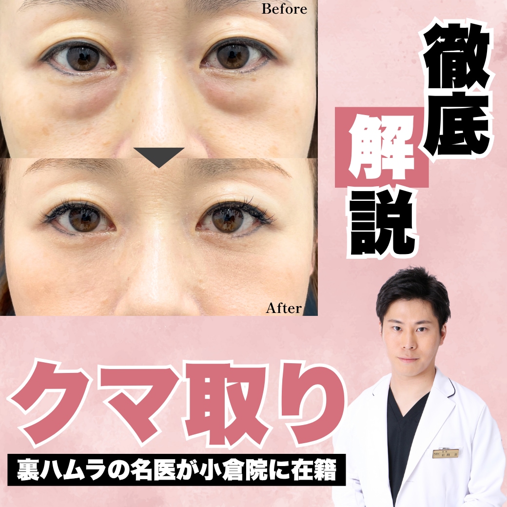 【福岡 裏ハムラ】目の下のクマ・たるみ治療の名医｜SBC小倉院・岩間医師が叶える自然な若返り
