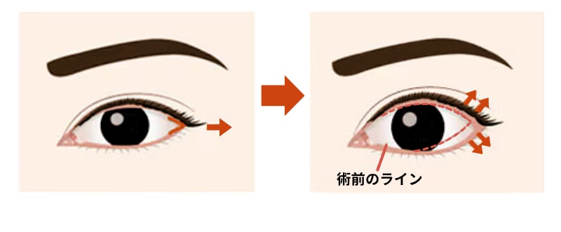 どこを切るの？切開ラインで変わる“目元の印象”