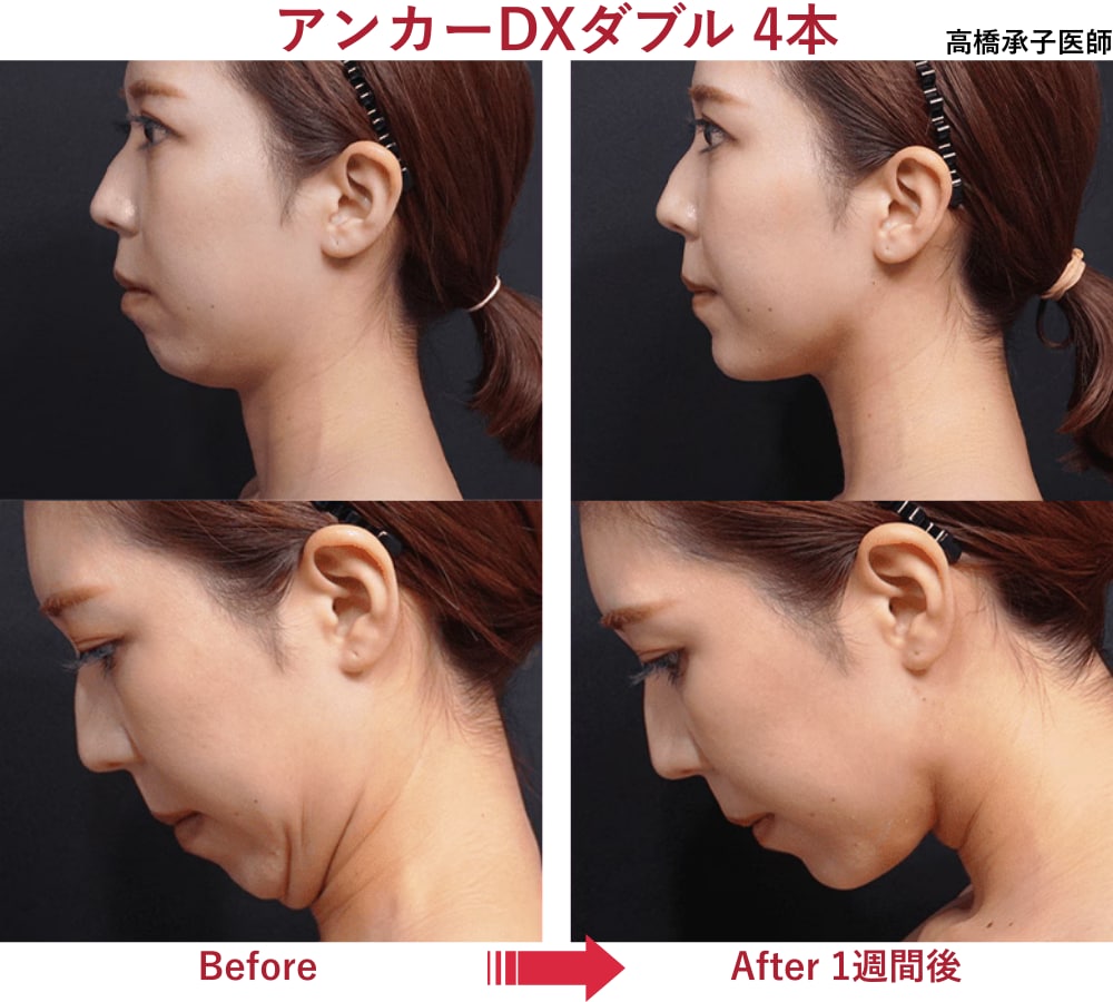 顎下すっきリフト症例