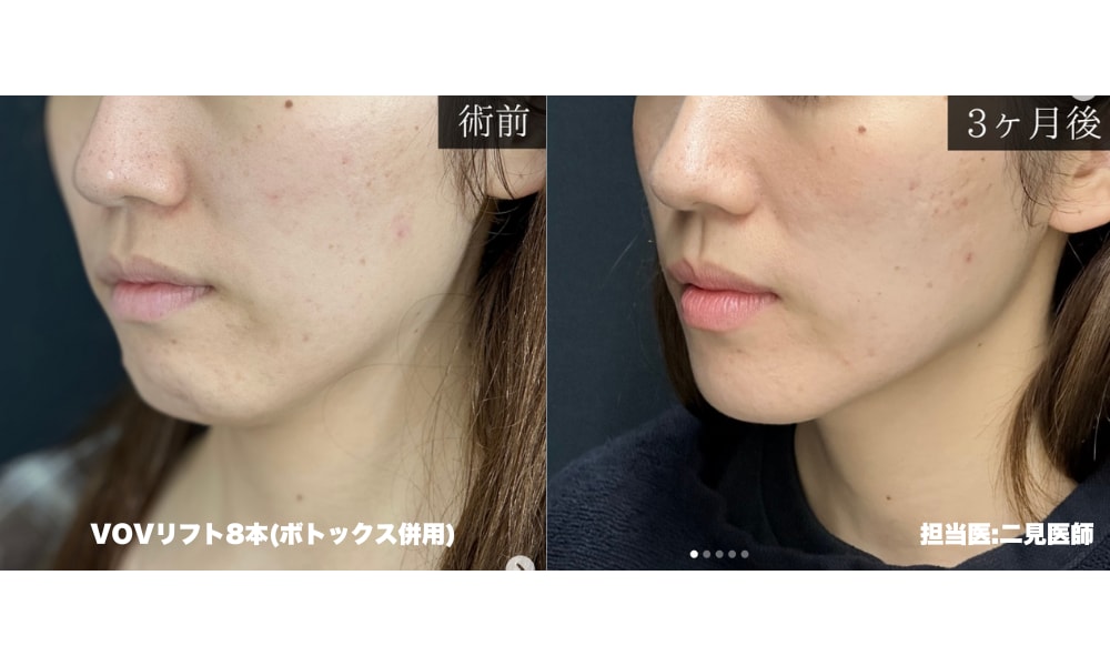 VOVリフト症例