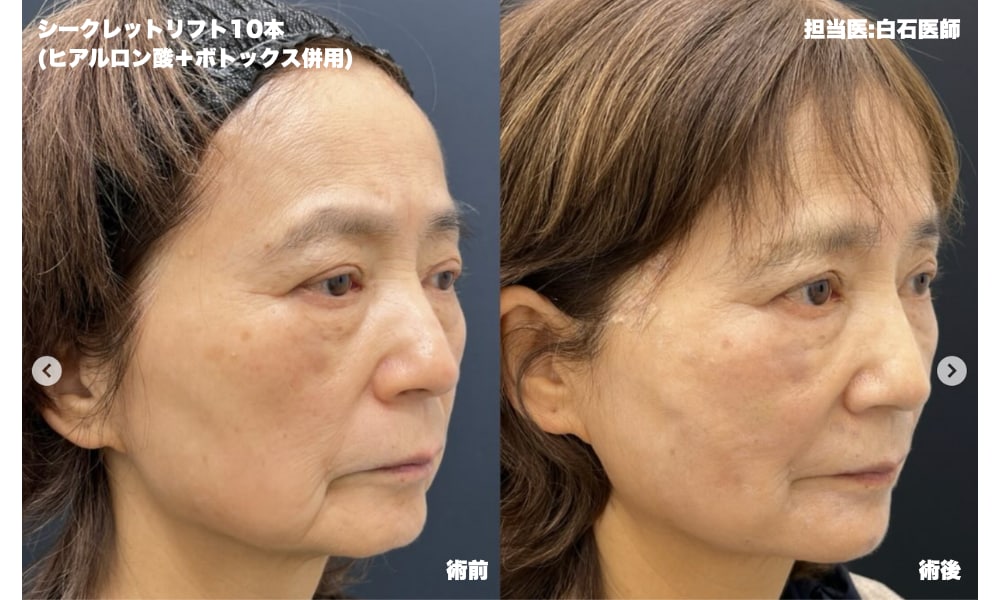 シークレットリフト症例<br />