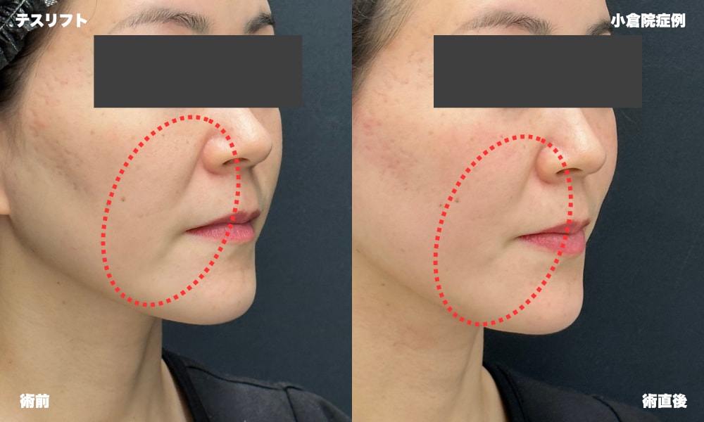テスリフト症例