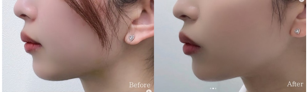 人中短縮ボトックス
