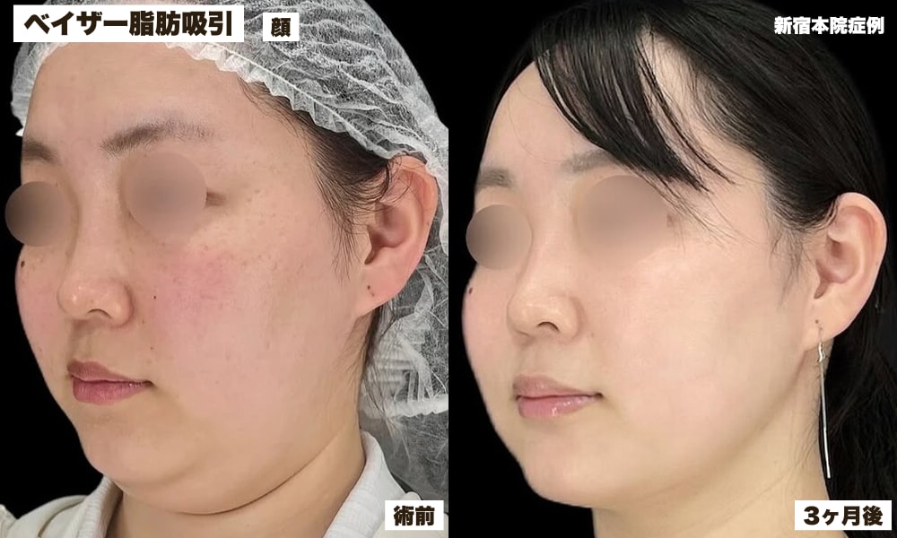ベイザー脂肪吸引症例