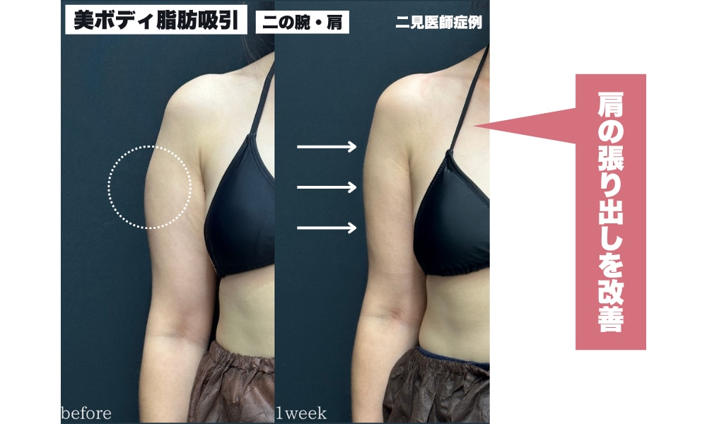 美ボディ脂肪吸引の症例
