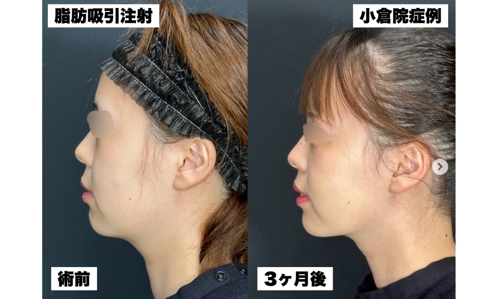 脂肪吸引注射の症例