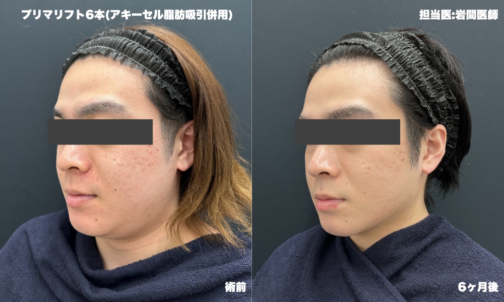 プリマリフト症例