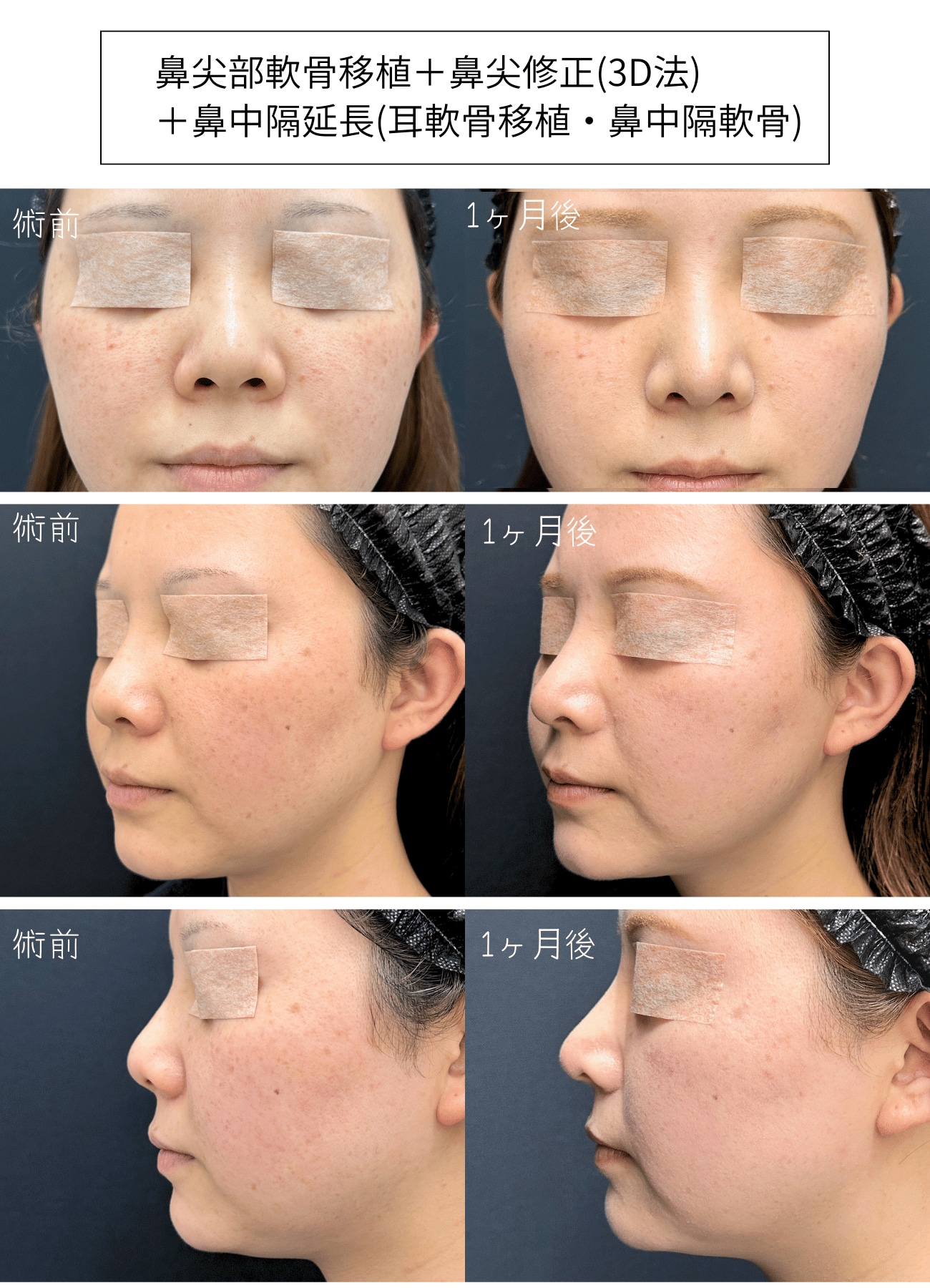 鼻孔が気にならない美鼻へ