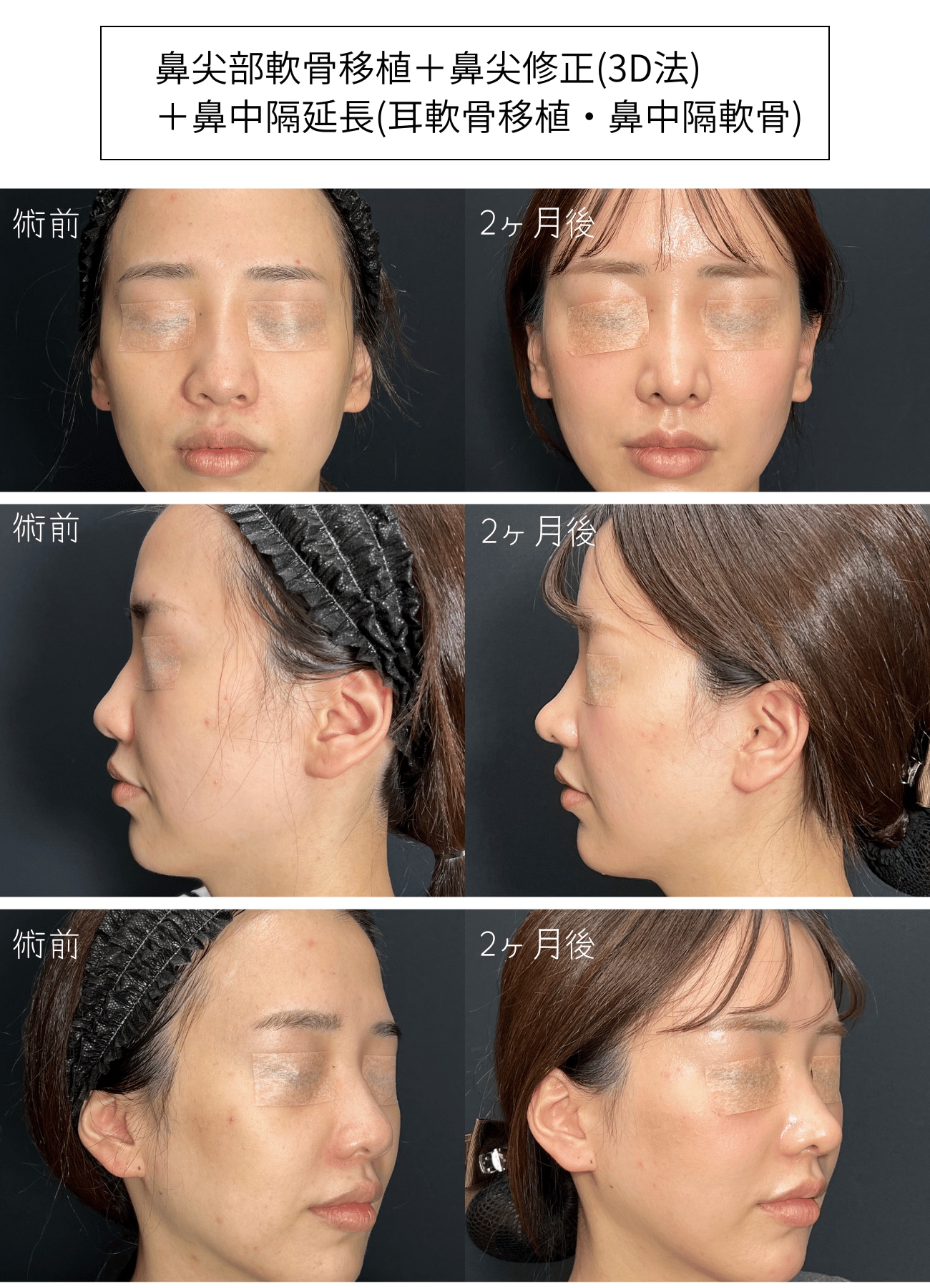 鼻先の厚みを解消！