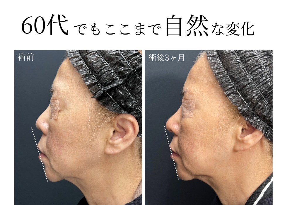 上品さ”を引き出す大人の鼻整形