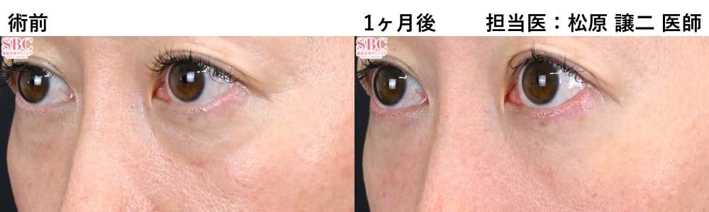 目の下のクマの改善