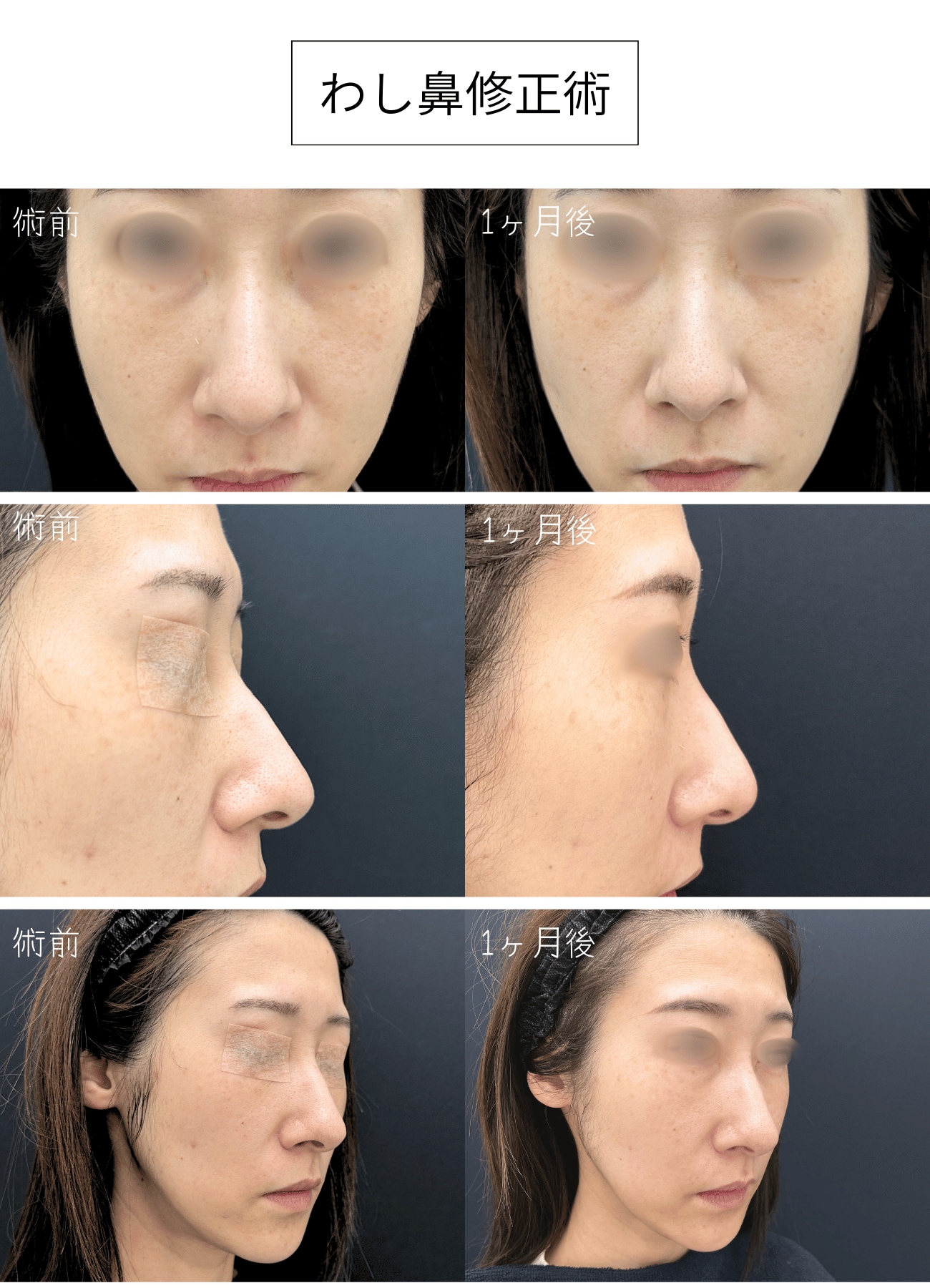 横顔の印象が劇的に変化！わし鼻改善で美シルエット