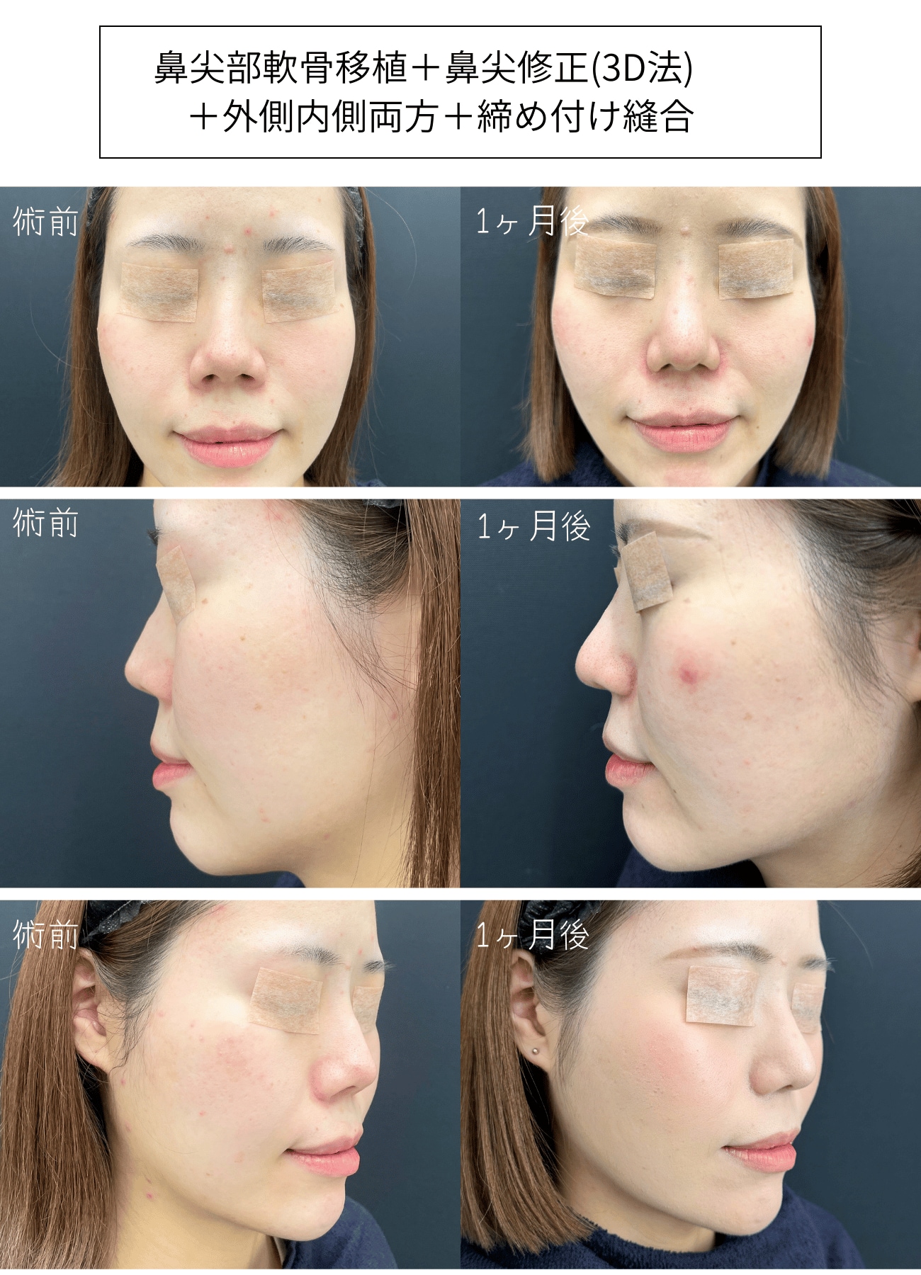 横顔のEラインを整える