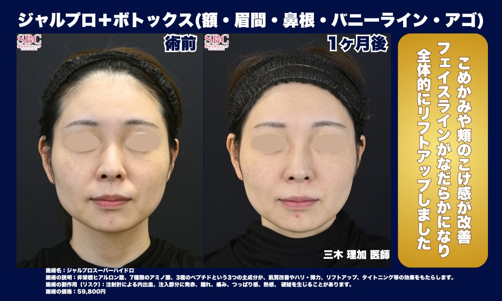 ジャルプロスーパーハイドロ＋ボトックス併用の症例写真
