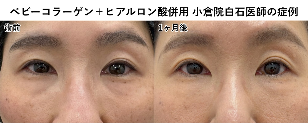 目の下のクマの改善