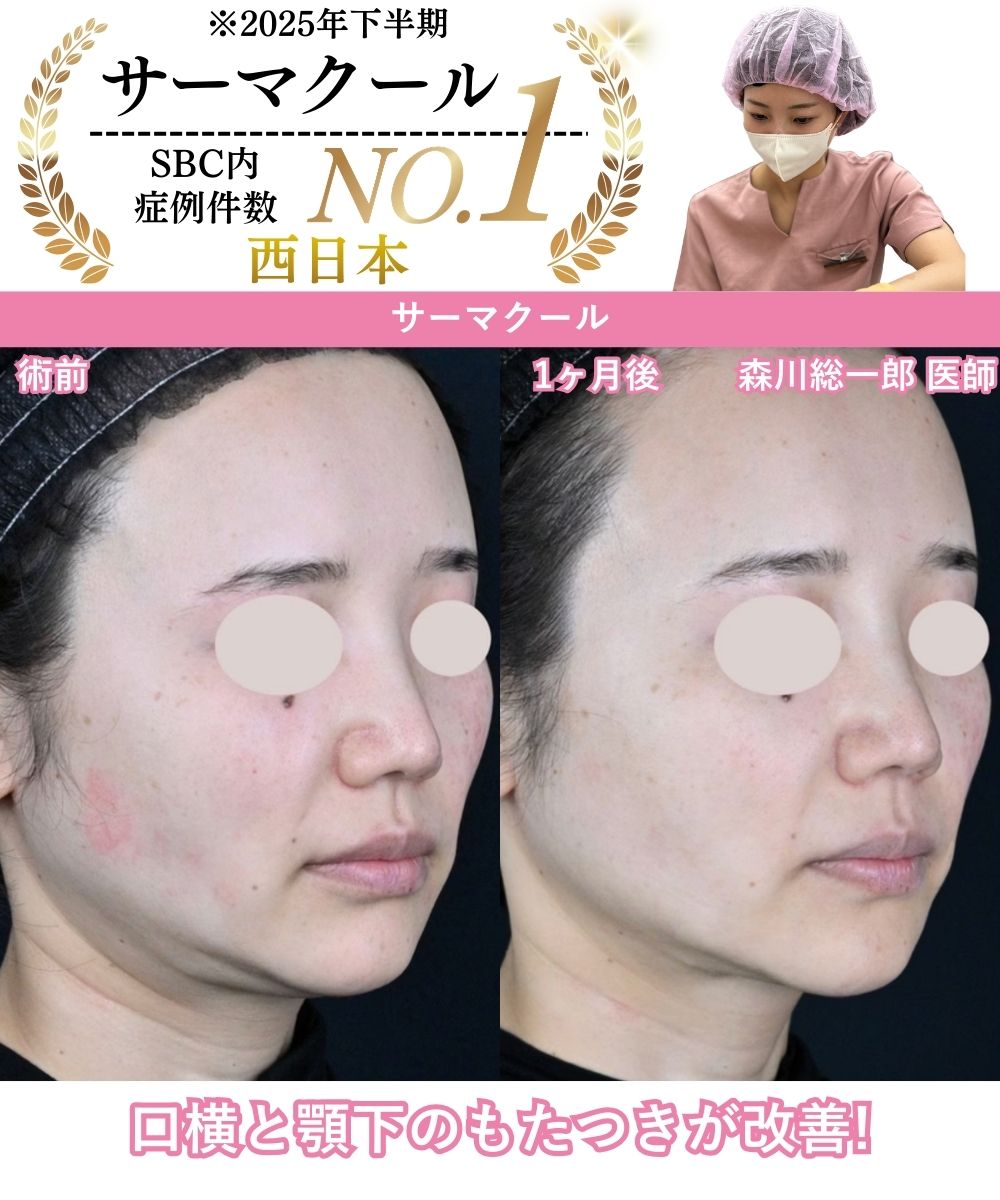 サーマクール・水光注射・シミ取りレーザー症例写真