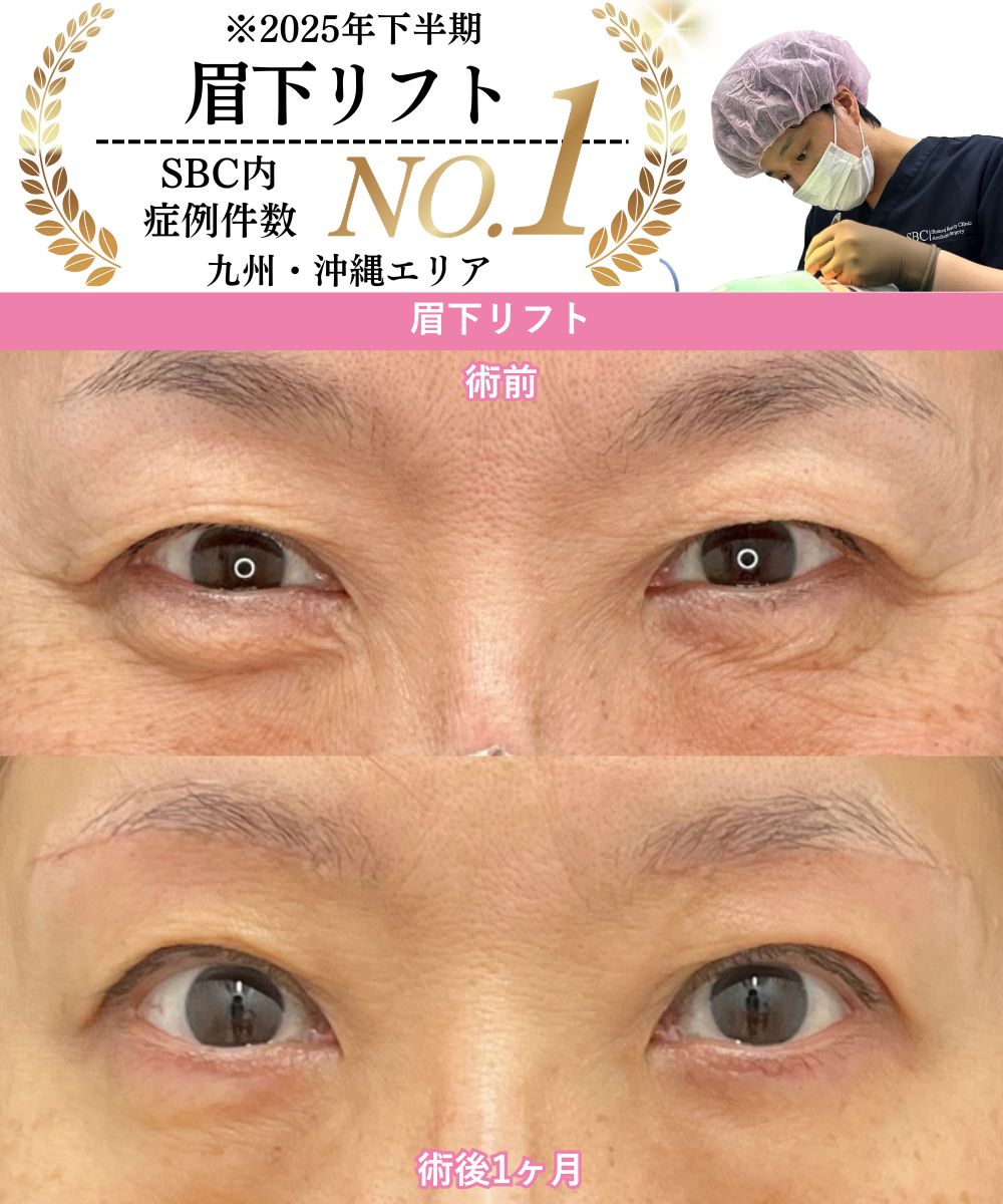 二見医師の眉下リフト症例