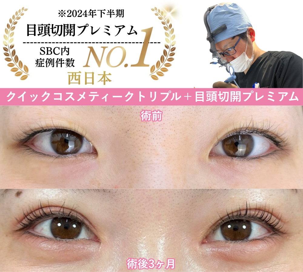 岩間院長の二重埋没症例