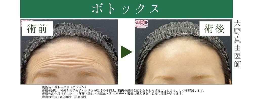 ③しわでお悩みの方のおすすめ併用治療