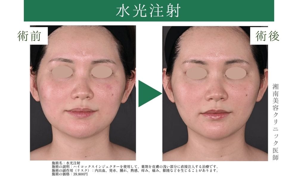 ④毛穴でお悩みの方のおすすめ併用治療