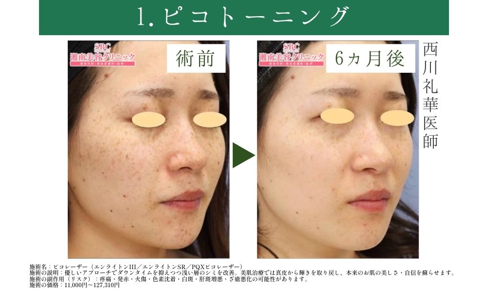 ①シミでお悩みの方のおすすめ併用治療