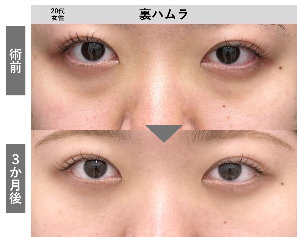 【20代女性】裏ハムラ