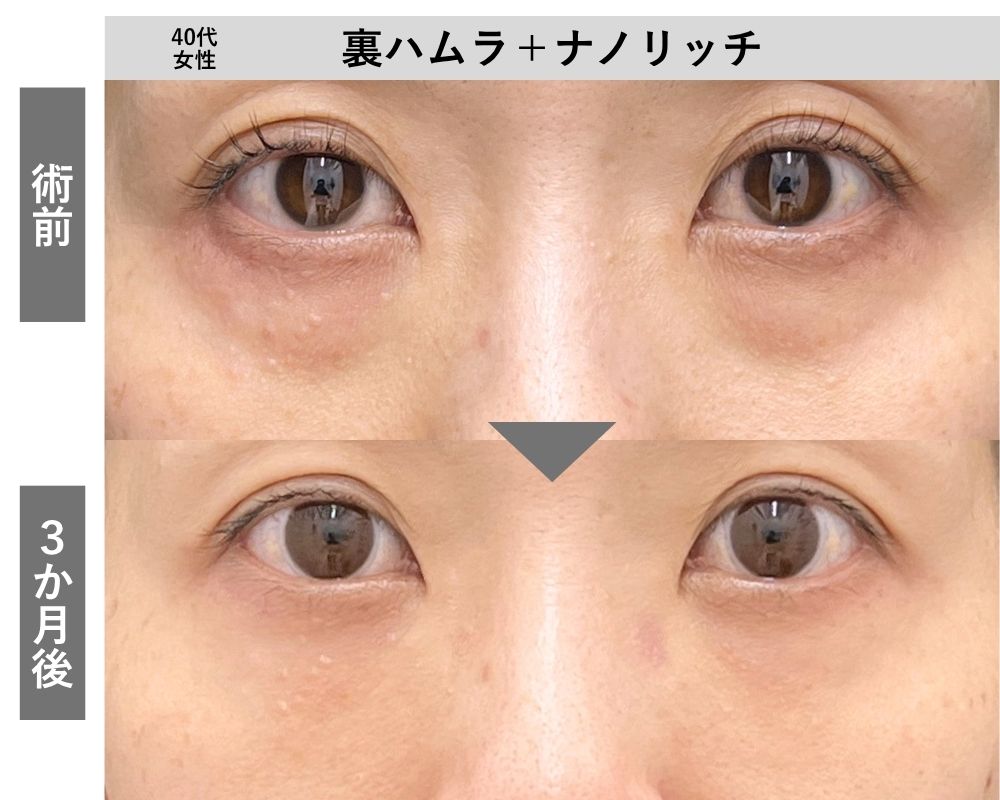 【40代女性】裏ハムラ＋ナノリッチ