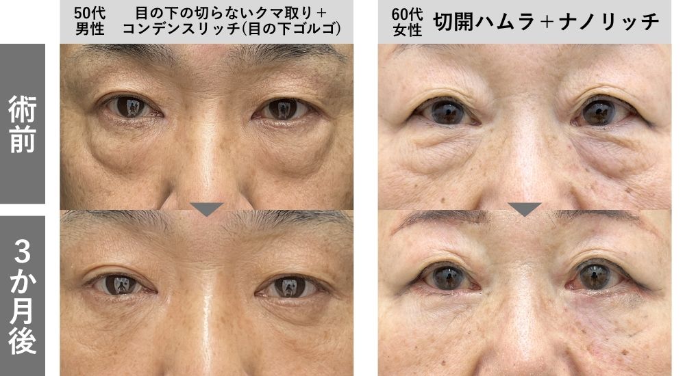 目の下の切らないクマ取り・たるみ（ふくらみ）取り＆切開ハムラ症例