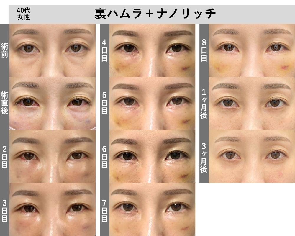 気になるダウンタイムの経過をご紹介