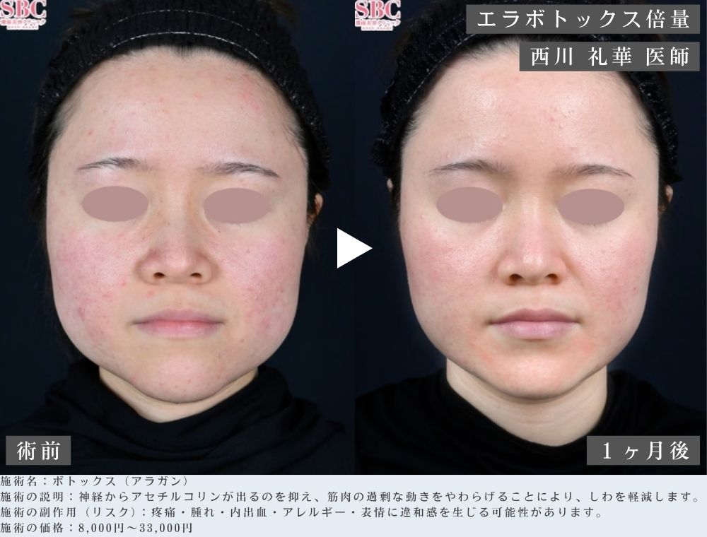 エラボトックスの症例写真