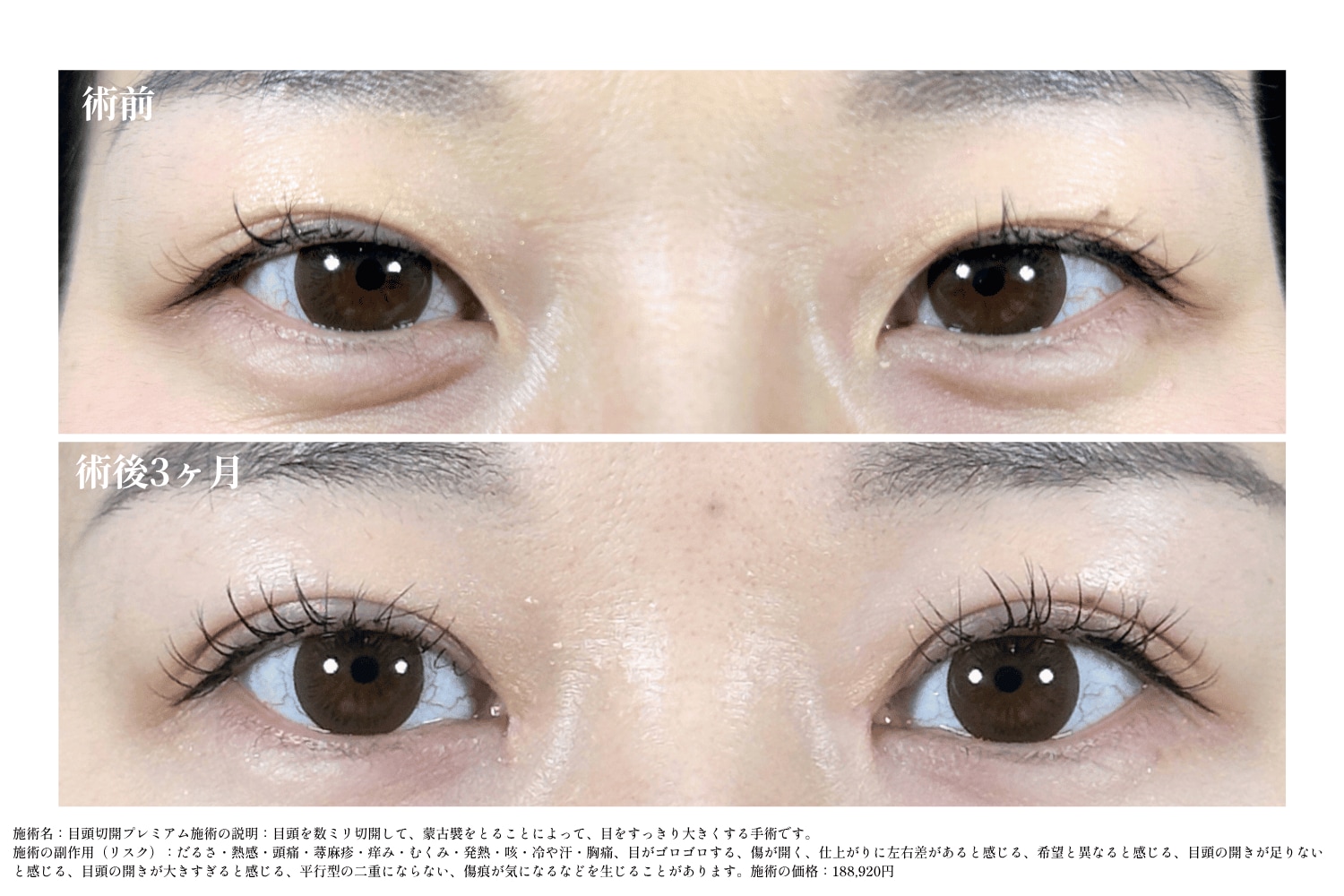 「埋没」×「目頭切開」で白目拡大が叶う！