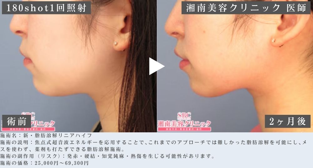 新・脂肪溶解リニアハイフの症例写真