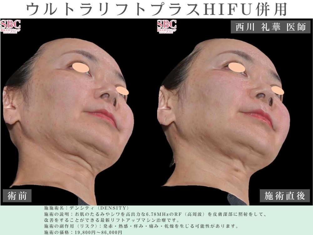 デンシティの症例